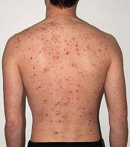 Chickenpox adult back