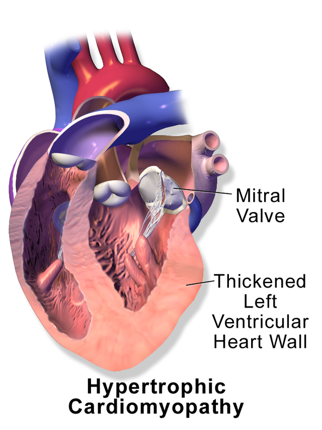 Hypertrophic cardiomyopathy