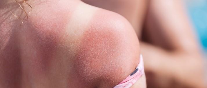 sunburn blisters