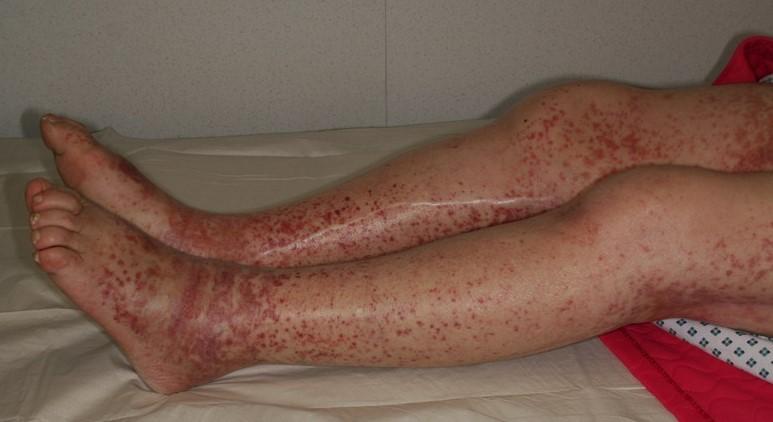 Henoch-Schönlein purpura