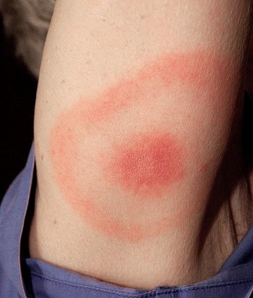 Lyme disease rash