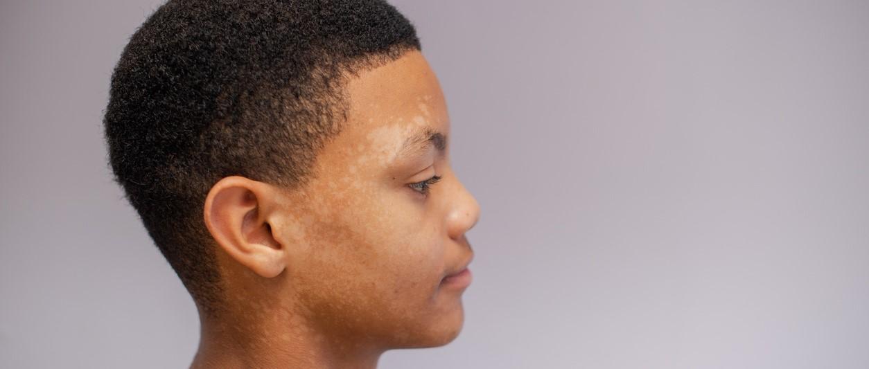 Common skin complaints: understanding tinea versicolor