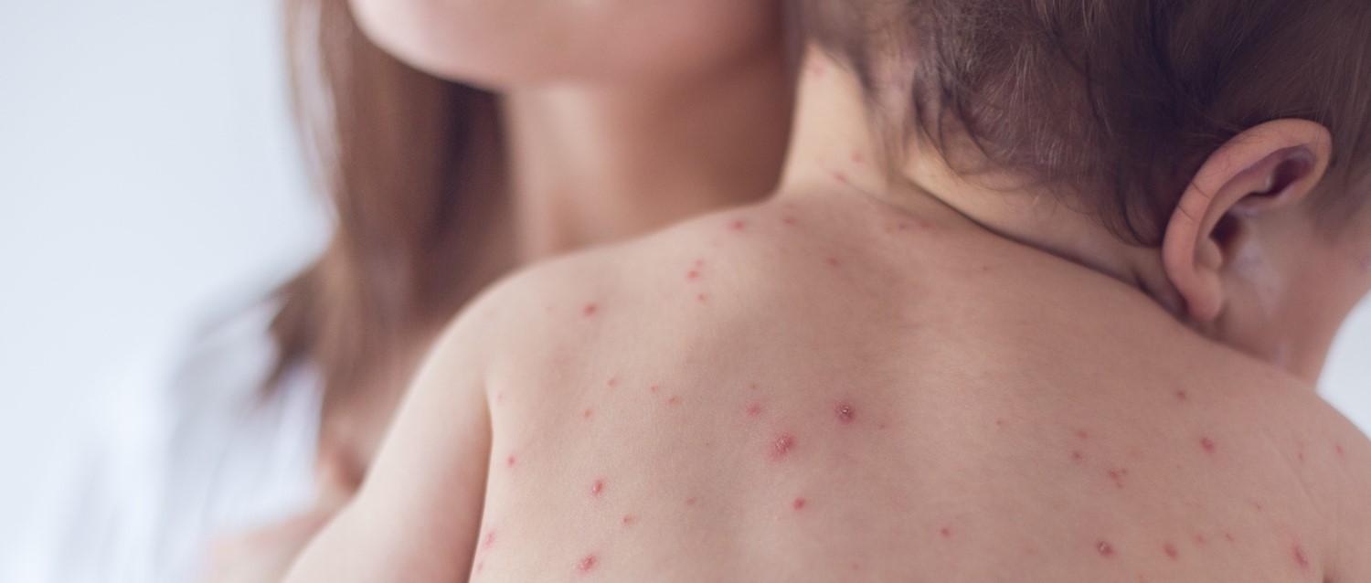 Chickenpox in children