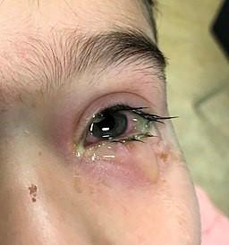 Bacterial conjunctivitis
