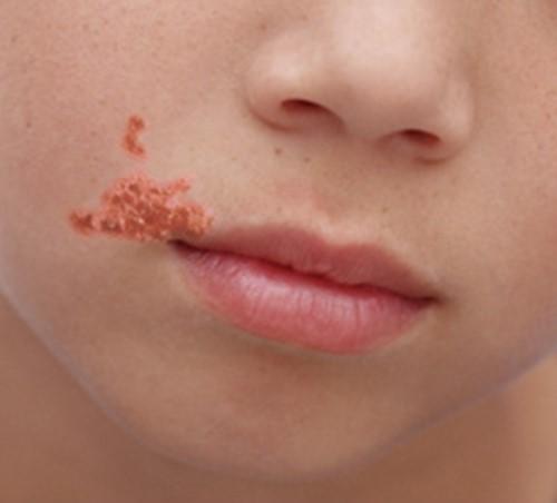 Impetigo close to mouth