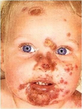 Facial impetigo
